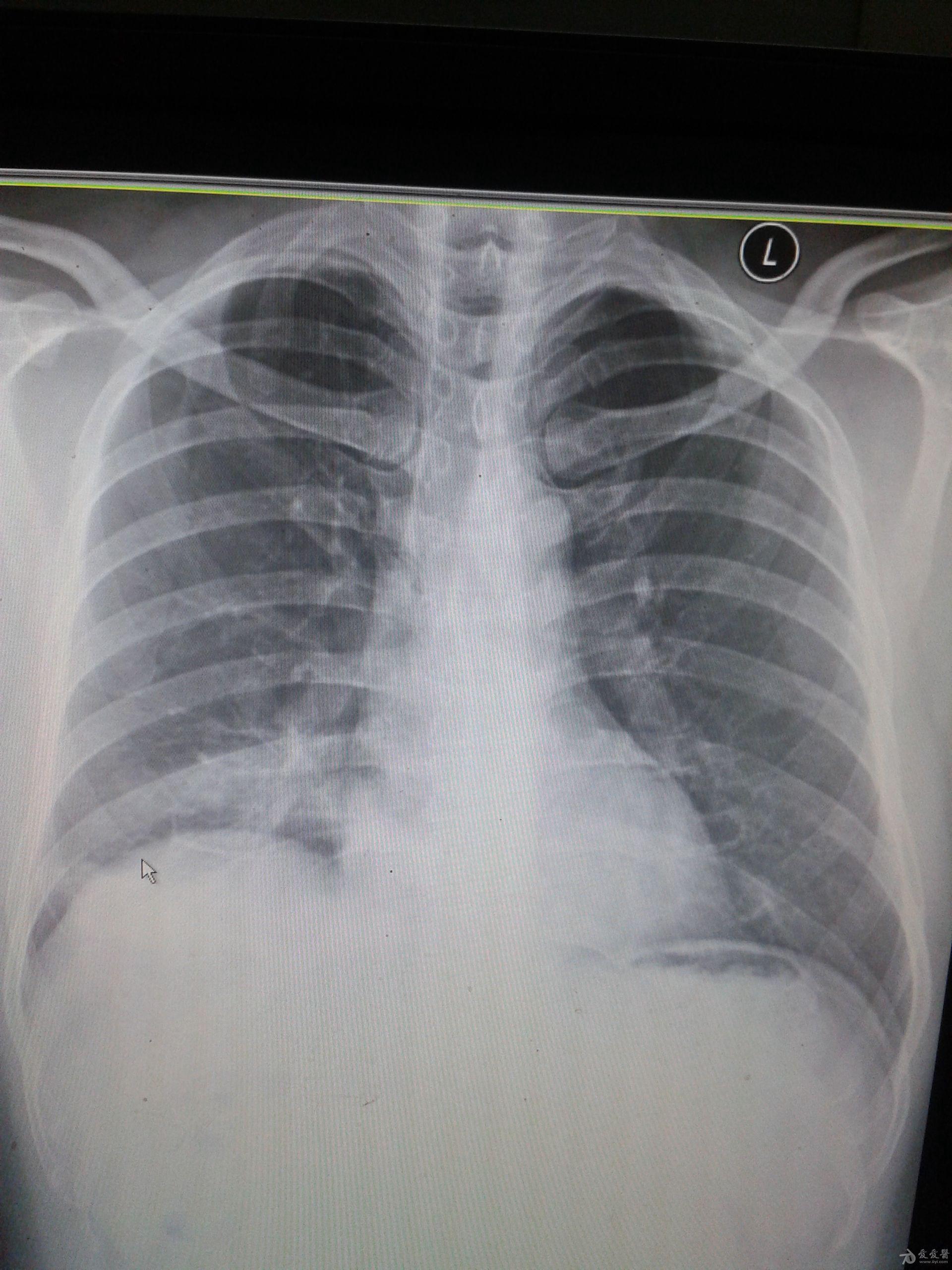 胸片能看出什么病 正常胸片和肺炎胸片图
