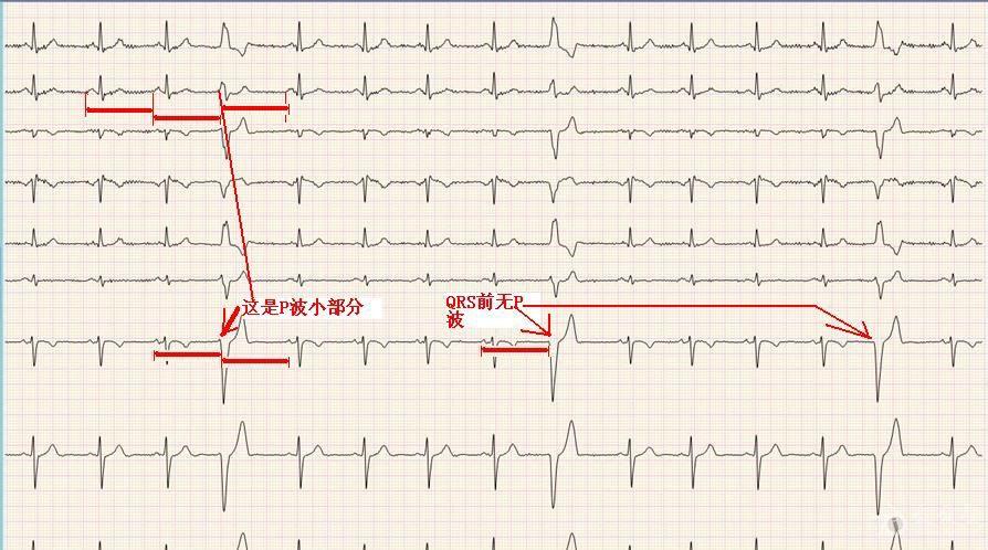 请山羊老师和版主看看这是间歇性完左还是室早啊