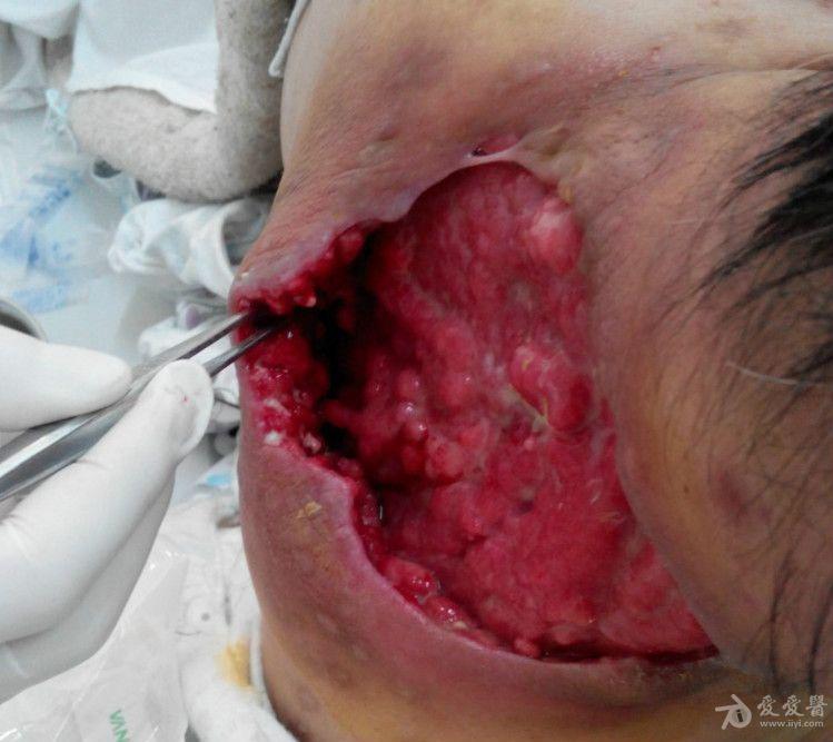 颈项部大片皮肤溃烂伴流脓10天