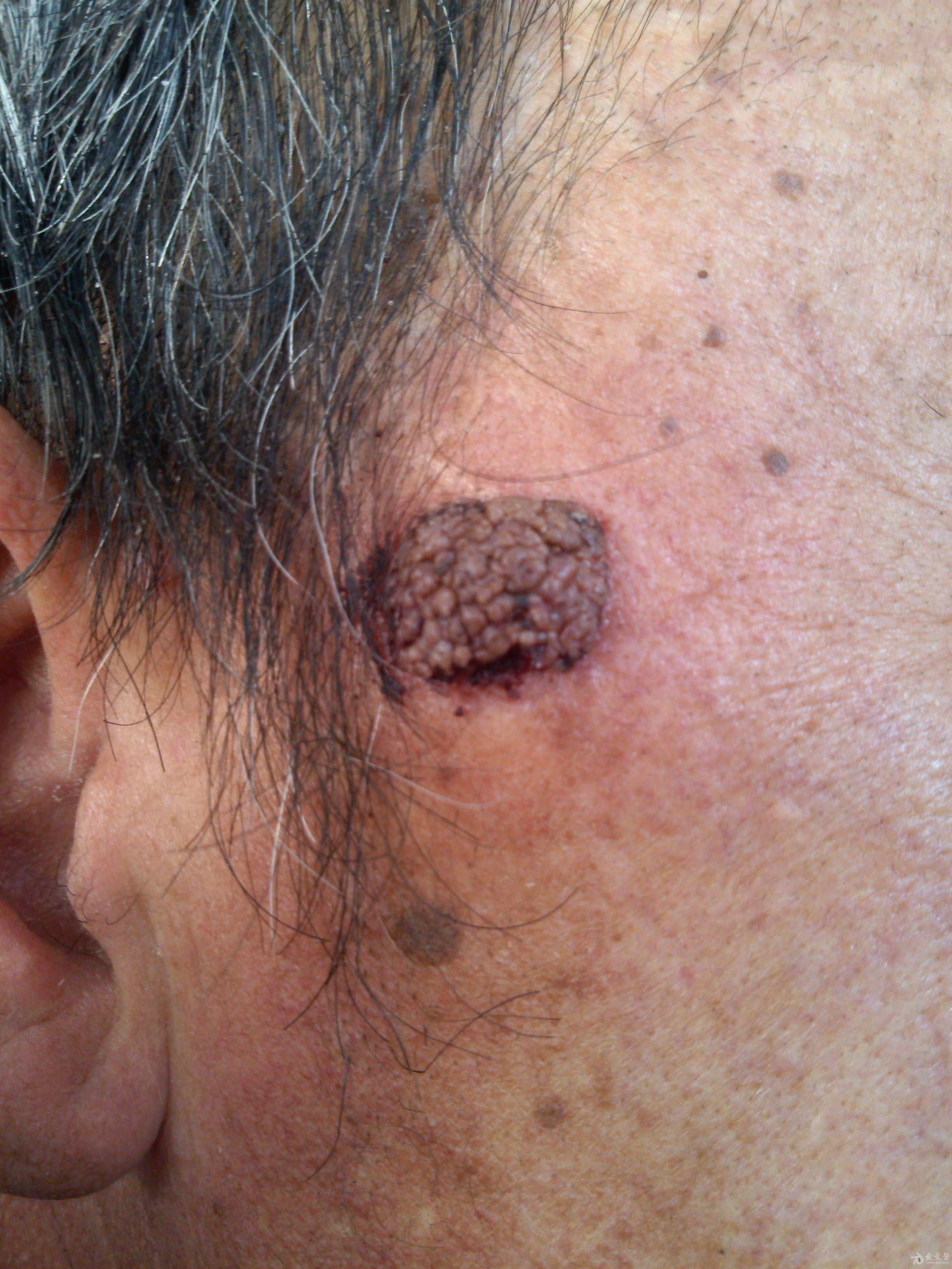 看图识病右面部皮损5年无自觉症状