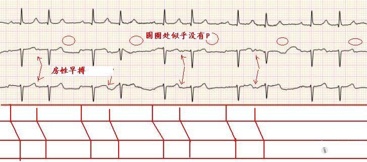 请山羊老师和版主看看,这是ii°i还是房早二联律啊