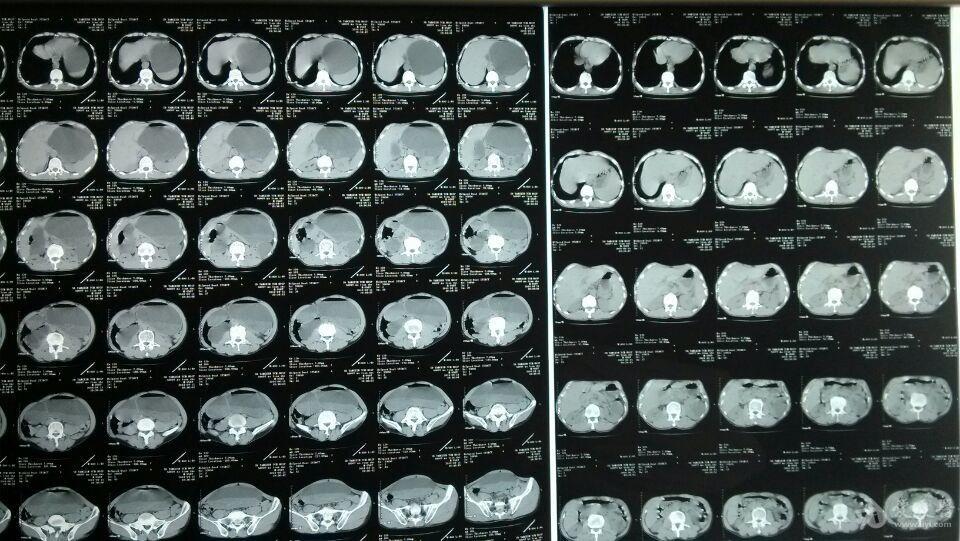 急性胃扩张治疗复查ct2jpg