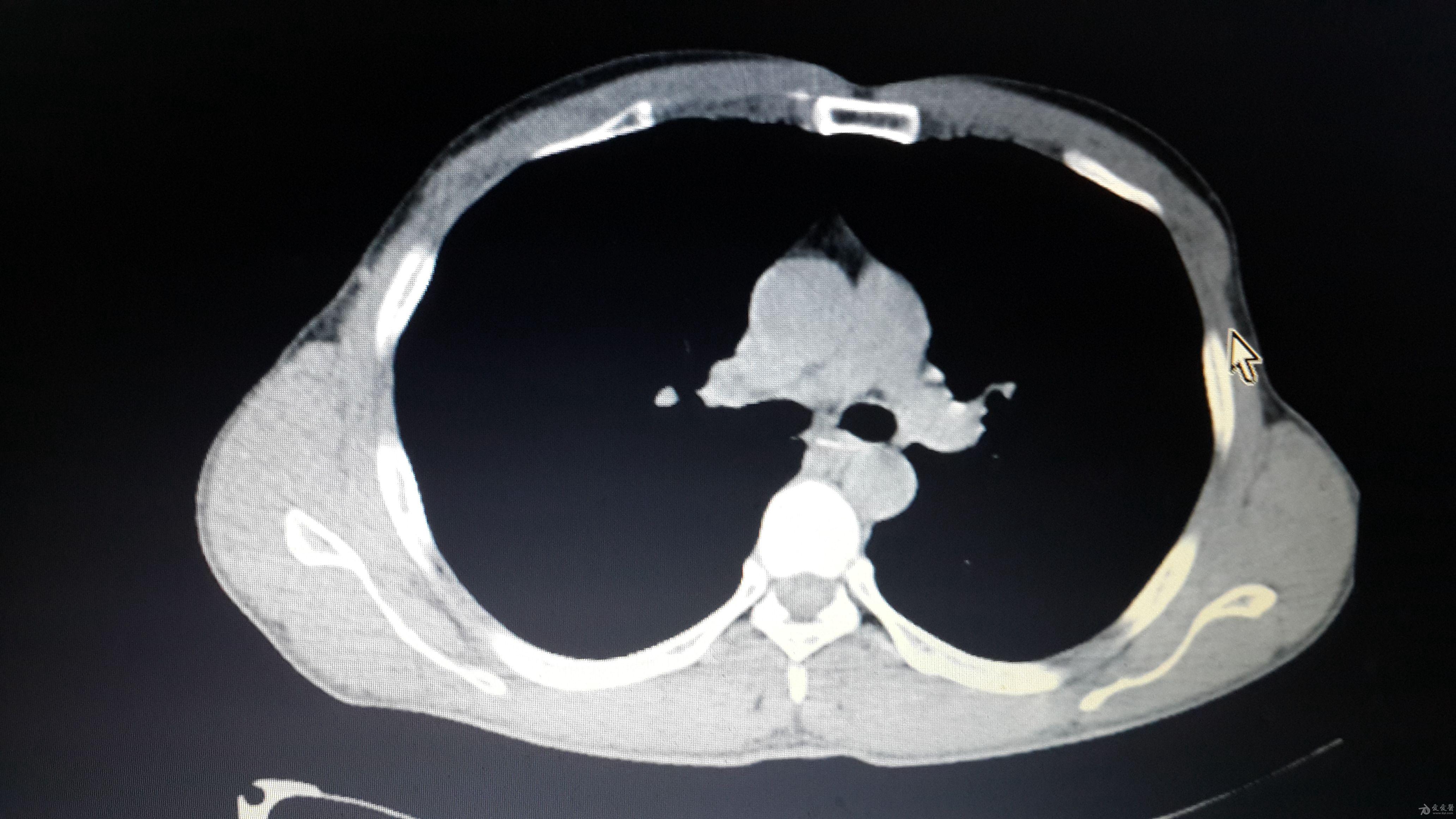 稍复杂的食道异物