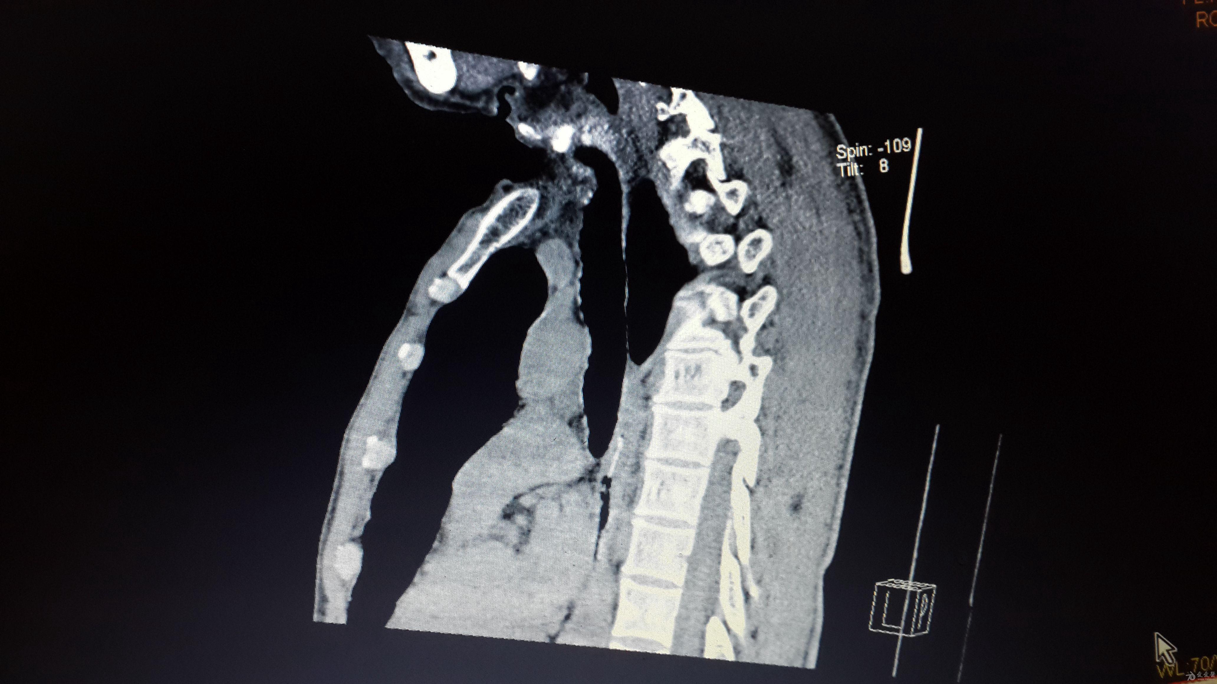 稍复杂的食道异物