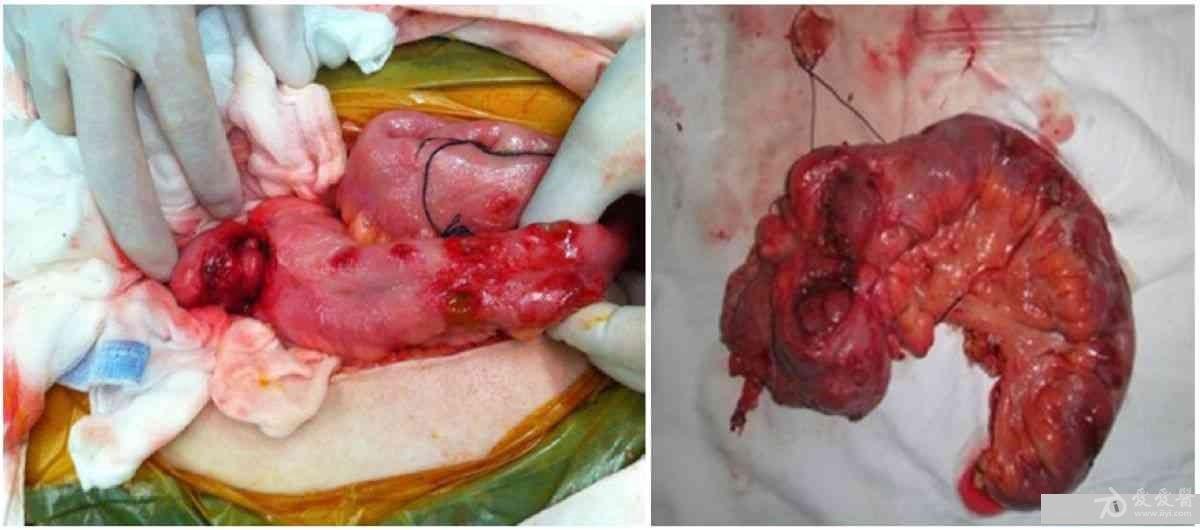 【学习】白塞病肠型--肠多发穿孔1例