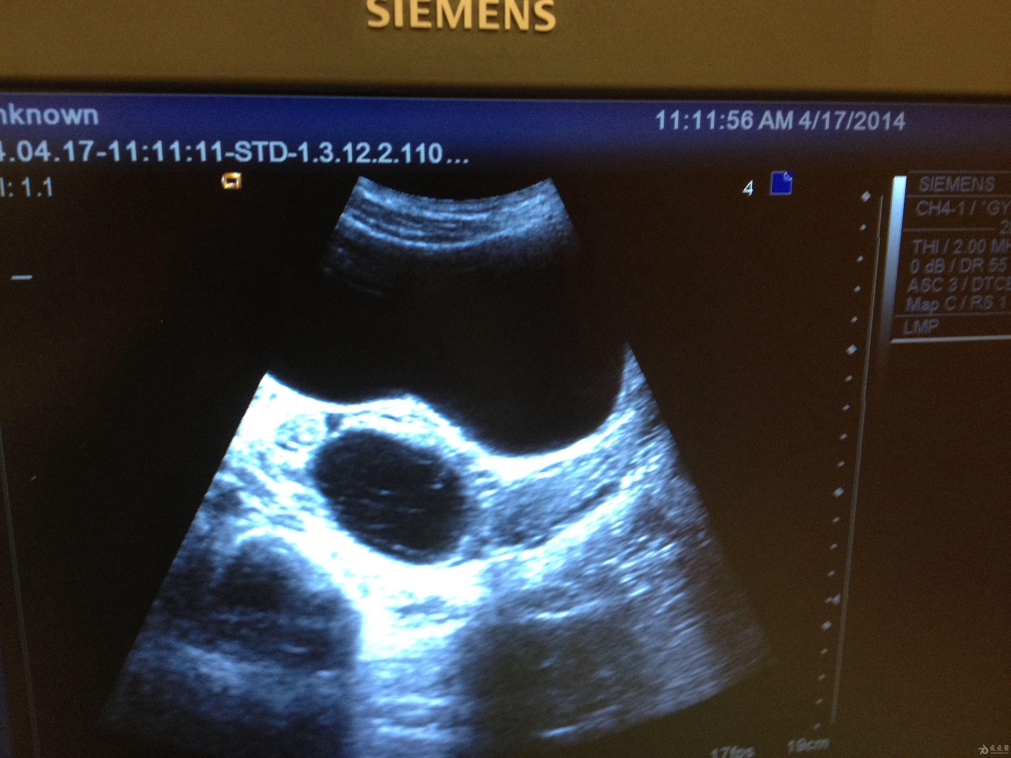 子宫左侧附件囊肿图片图片