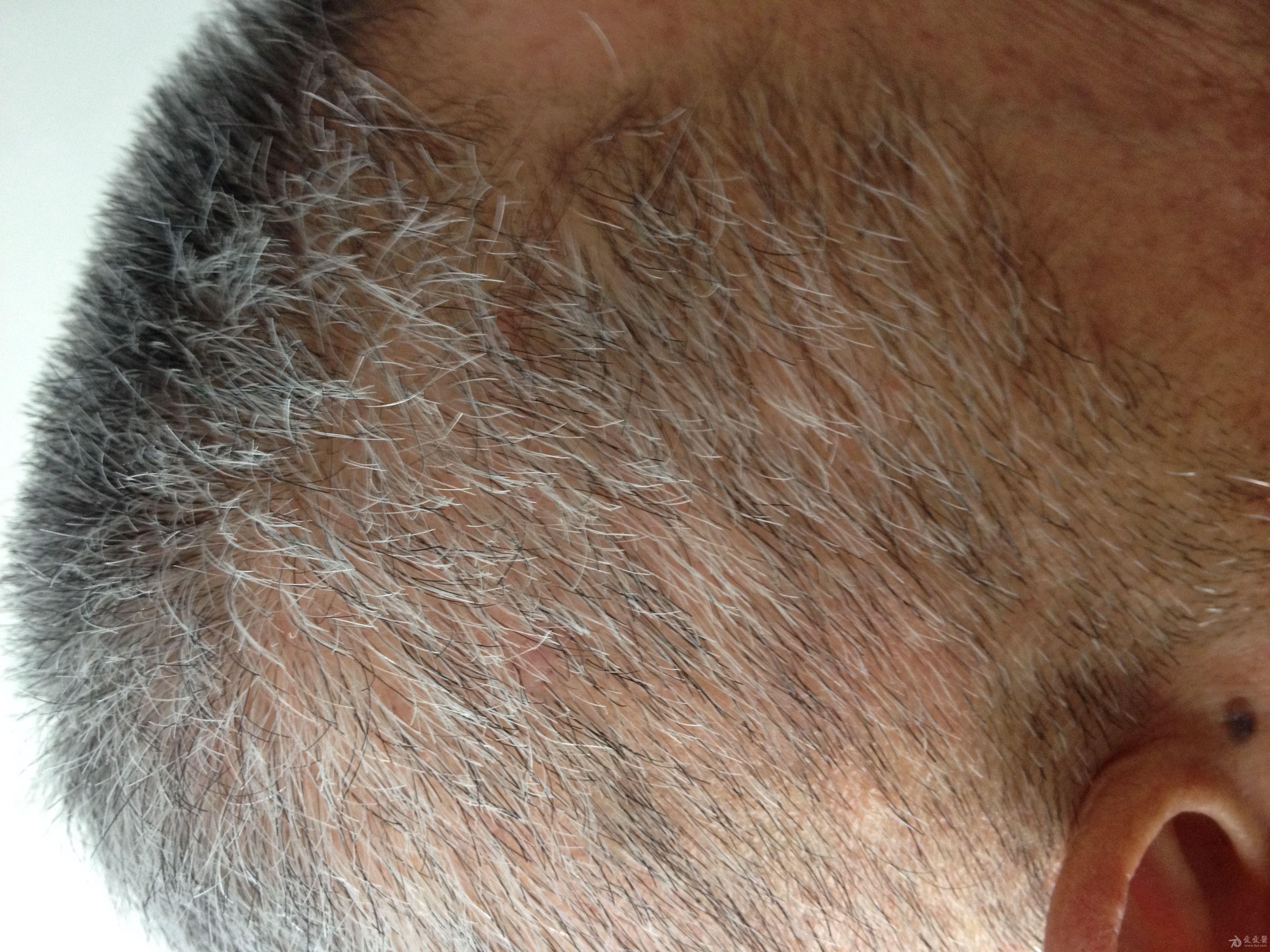 皮肤瘙痒头部多发性丘疹