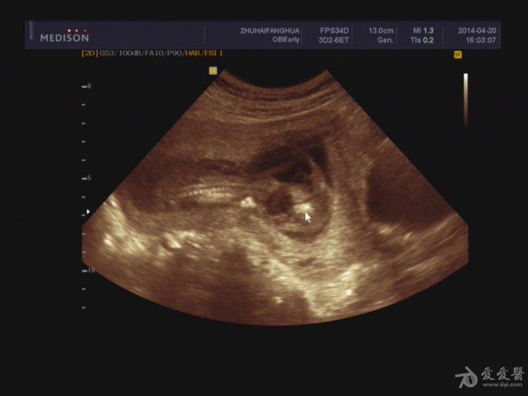 孕妇水囊图片