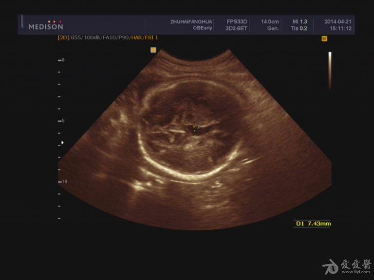 是胎儿第三脑室扩张还是透明隔腔扩张