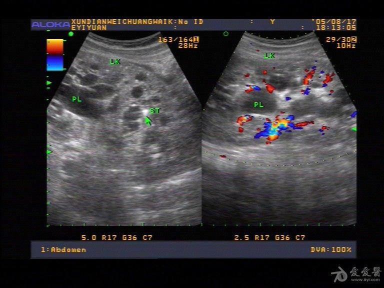 论坛 69★临床检查区 69 超声医学讨论版 69 多囊肾,膀胱里