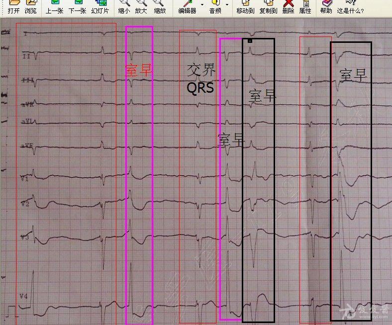 冬秋心電圖討論20140426房顫