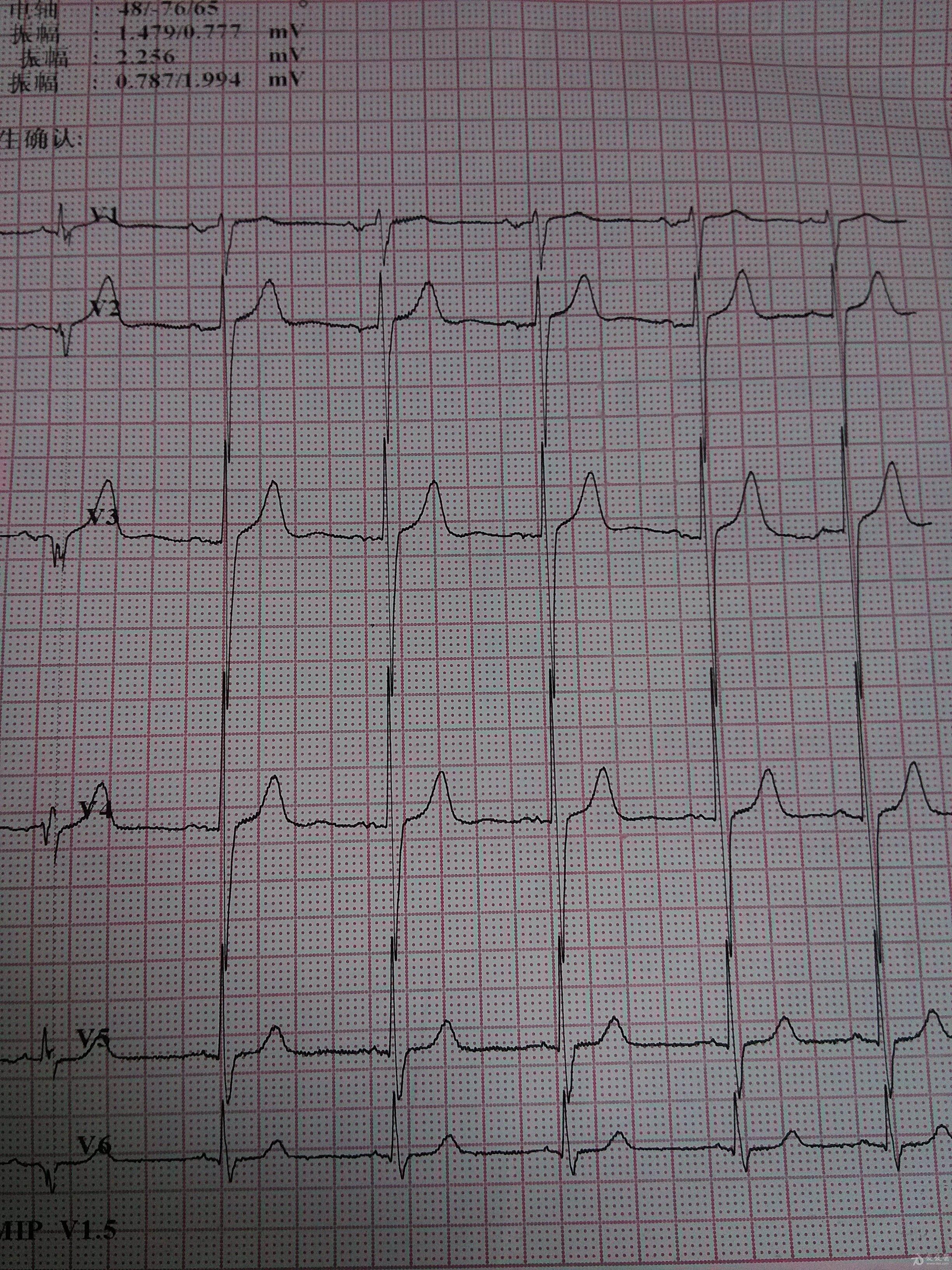 心电图电压高图片