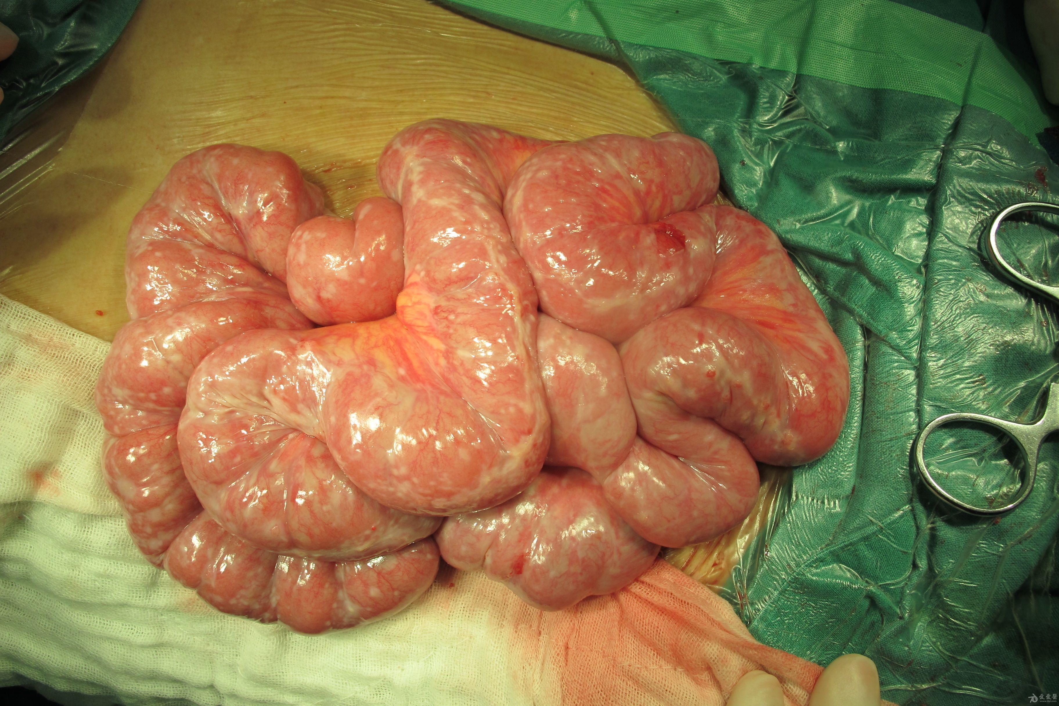 大家看一下这是不是腹茧症