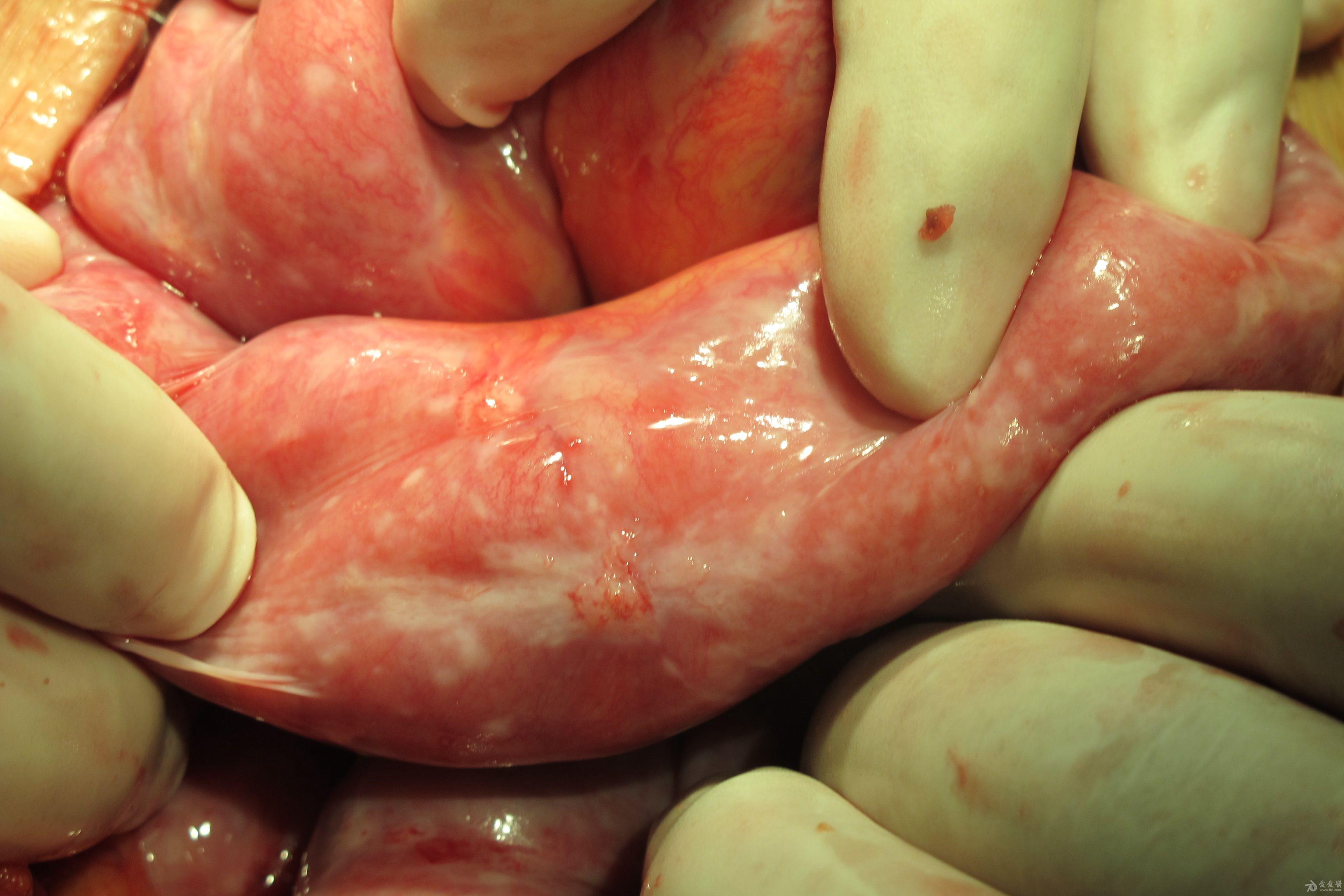 大家看一下这是不是腹茧症