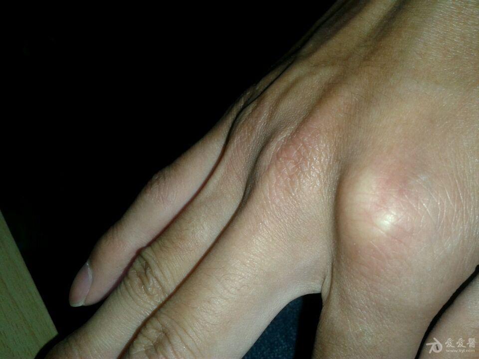 食指腱鞘炎的症状图图片