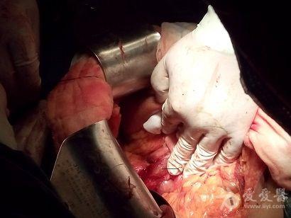 新鲜的胰十二指肠切除术手术图片
