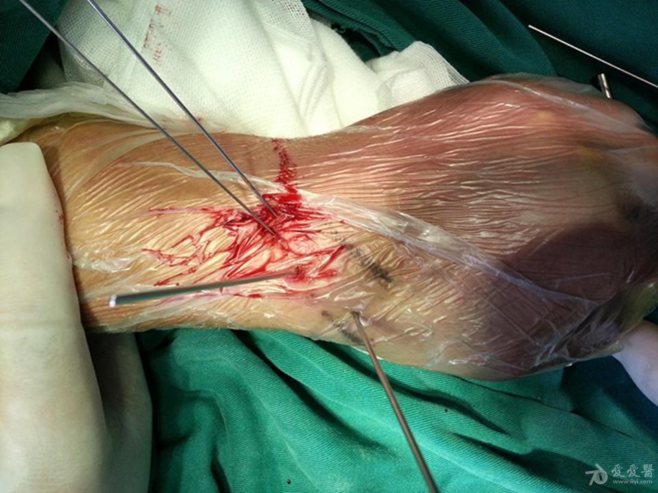 舟状骨骨折 手术图片