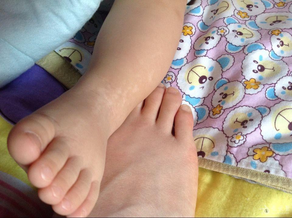 宝宝腿上有一小块白斑图片