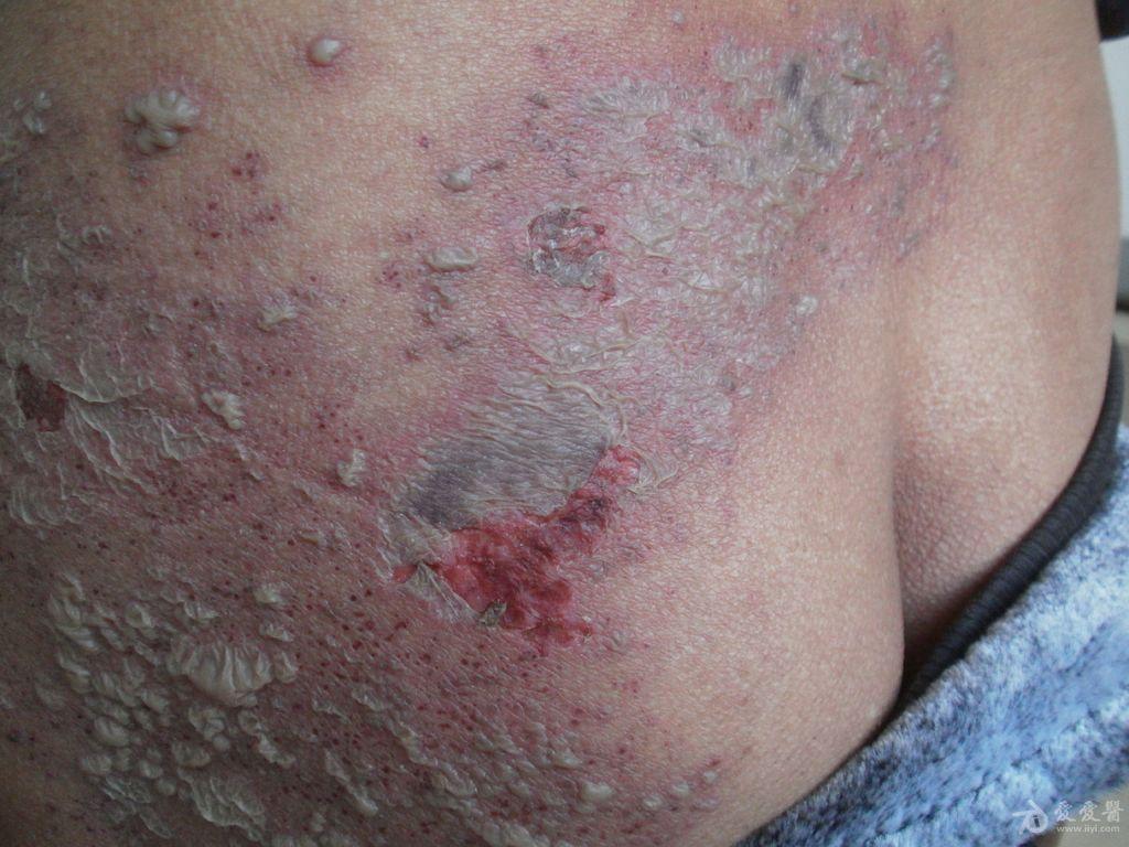皮肤及性传播疾病讨论版 - 爱爱医医学论坛
