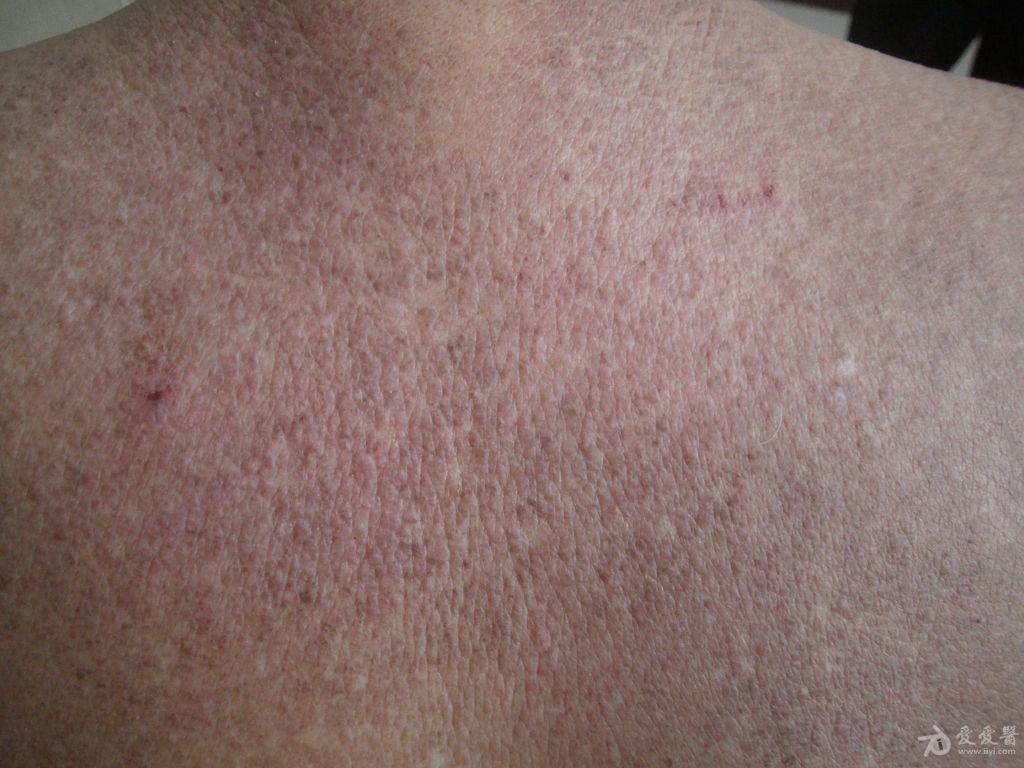 皮肤淀粉样变一例