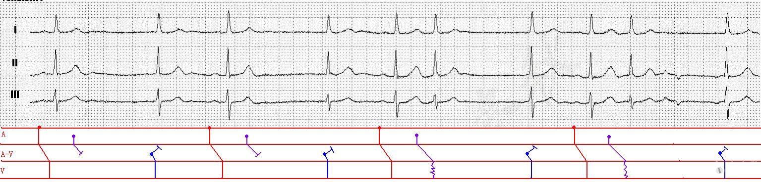 1,竇性心律 2,頻發房早(房早未下傳,房早伴差傳)3,交界區逸搏
