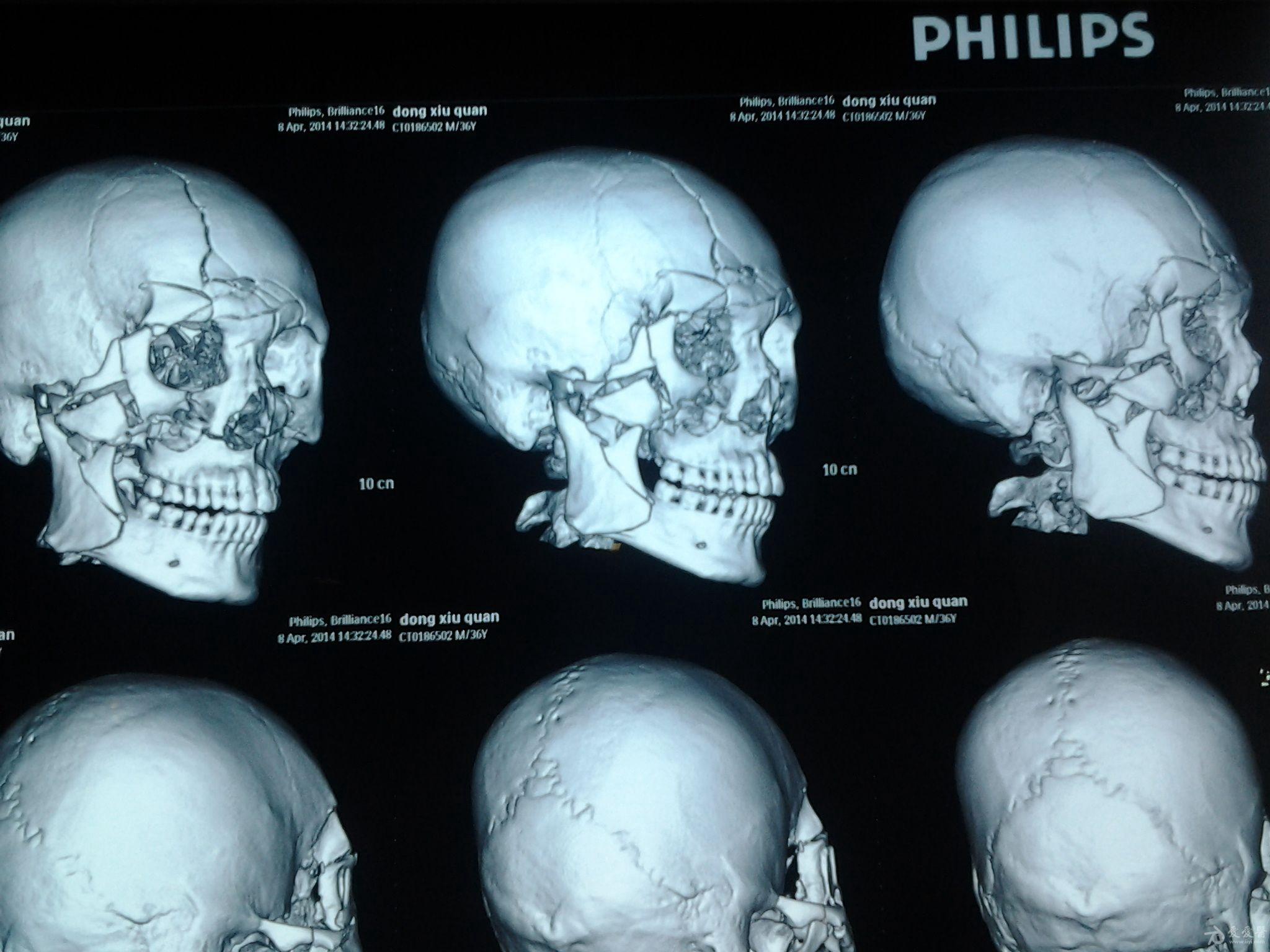 头骨骨折x光片图片