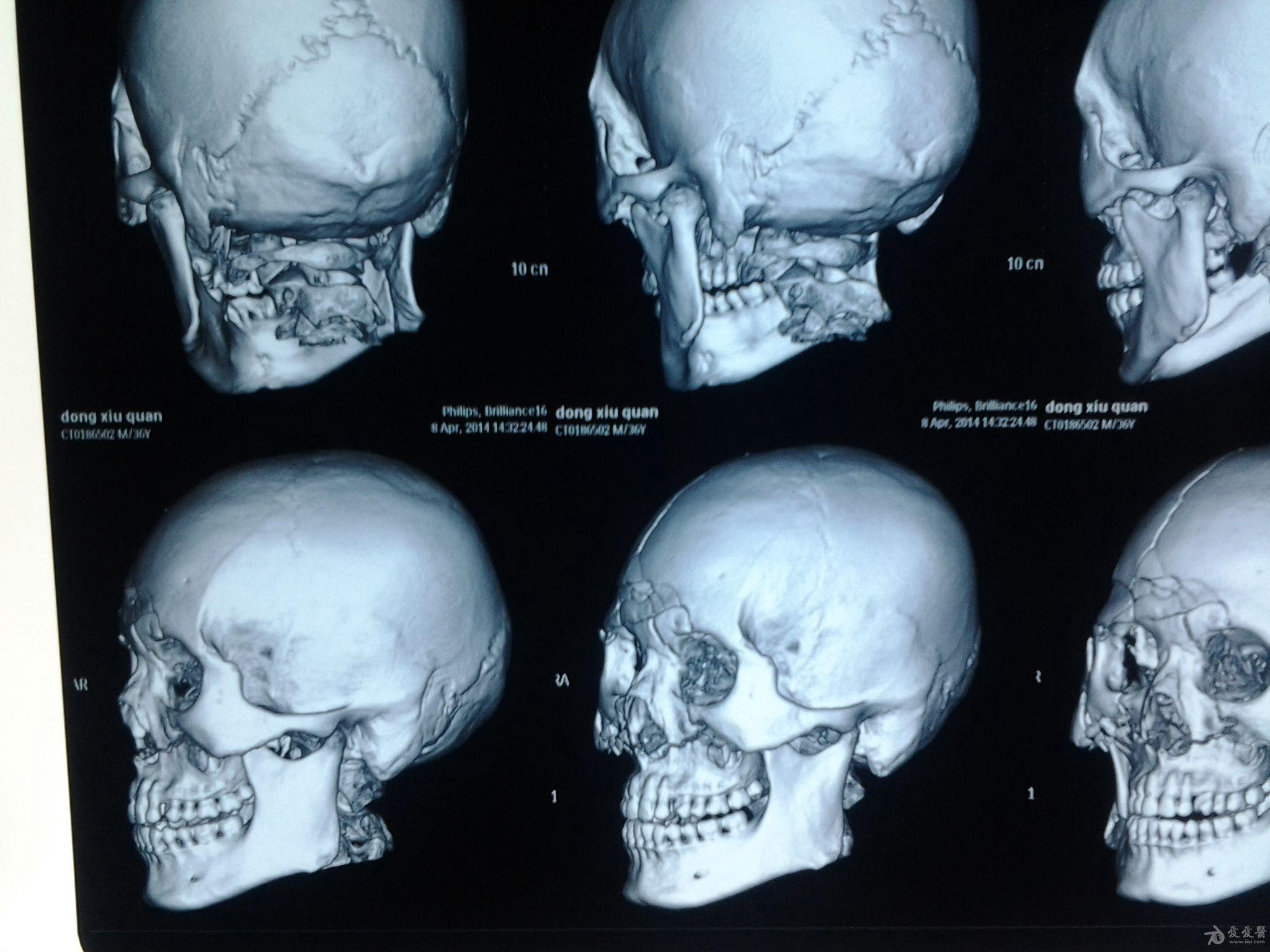 头骨骨折x光片图片