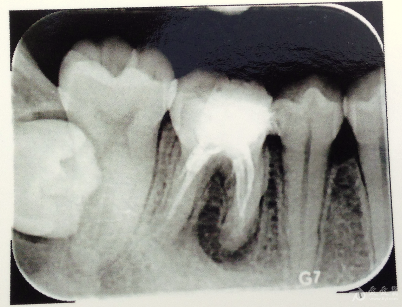 根管治疗后x光片图片图片