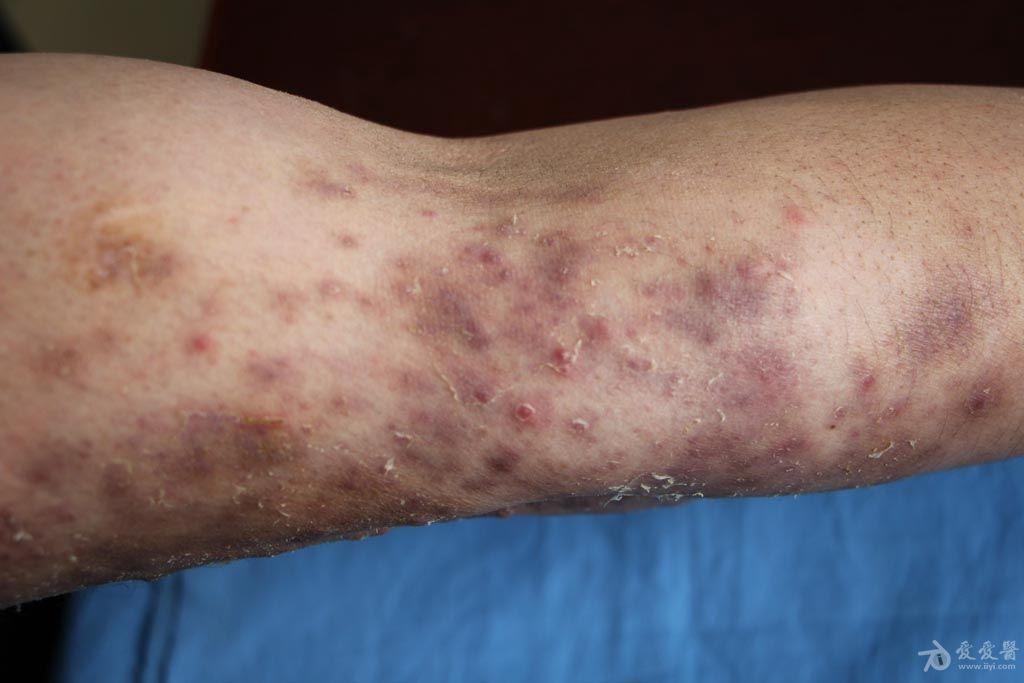 外用多种激素药膏后形成难治型"体癣" - 皮肤及性传播疾病讨论版