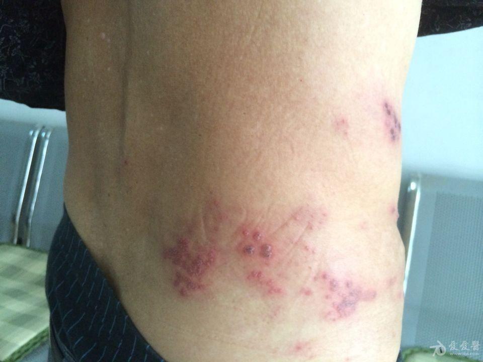 带状疱疹的治疗