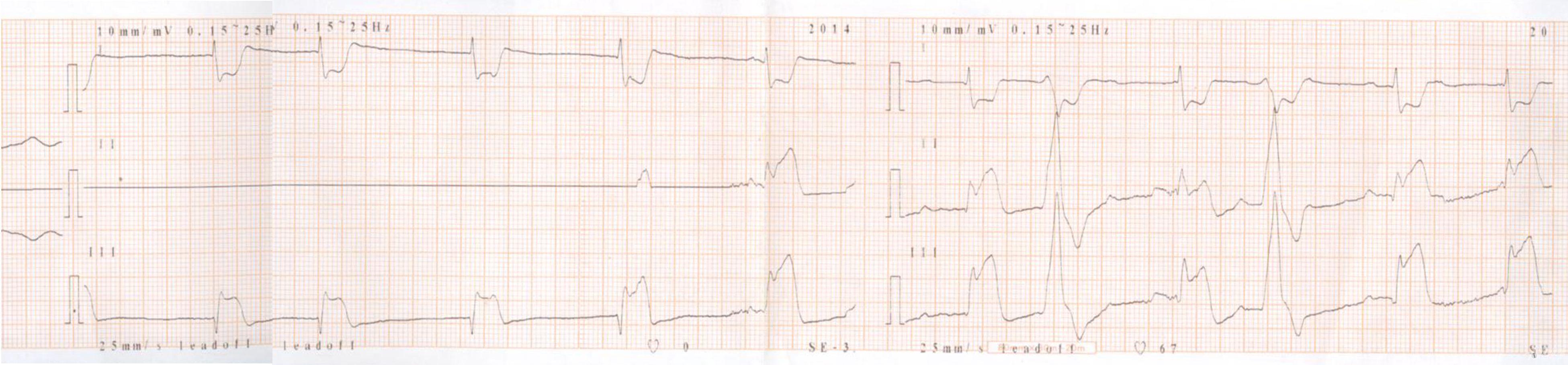 請教下壁心梗室顫後心電圖一份