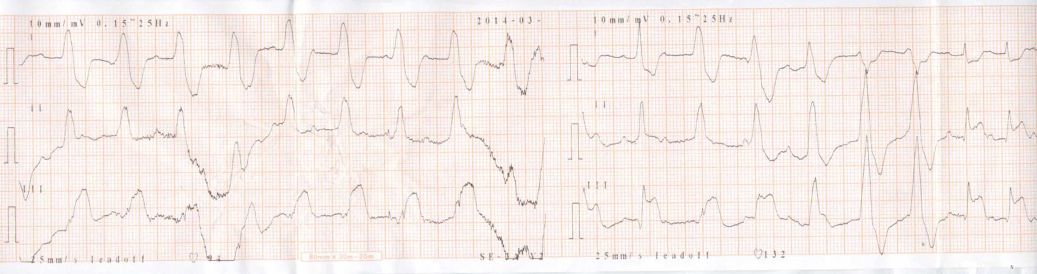 请教下壁心梗室颤后心电图一份