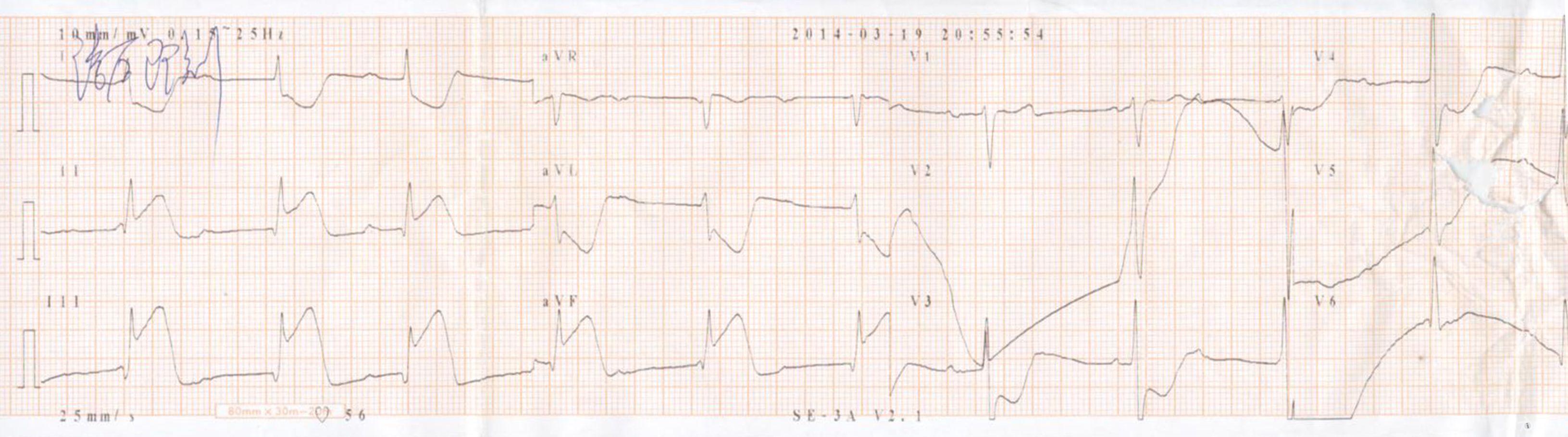 請教下壁心梗室顫後心電圖一份