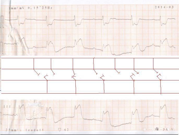 請教下壁心梗室顫後心電圖一份