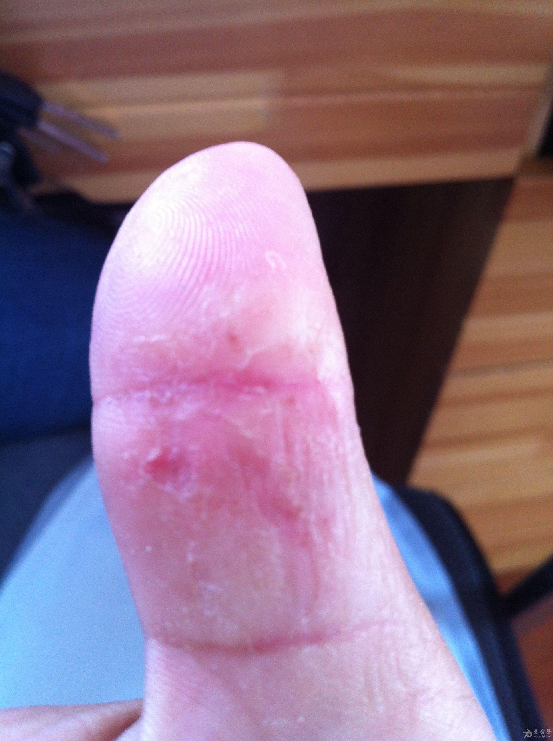 右手拇指,食指手癣一年,反复治疗未见好转,越发严重,希望高人帮帮我