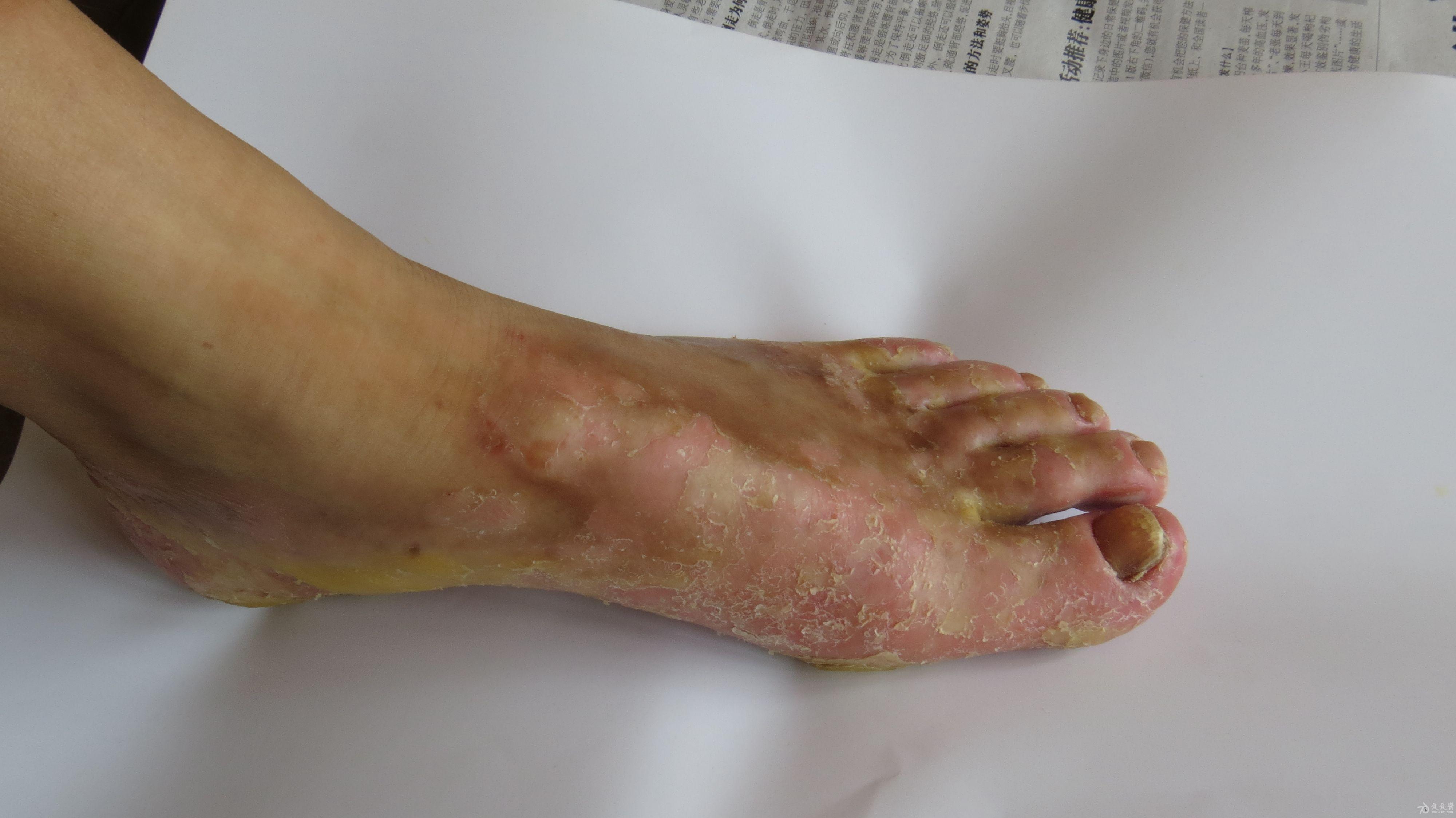 皮肤病30余年求助