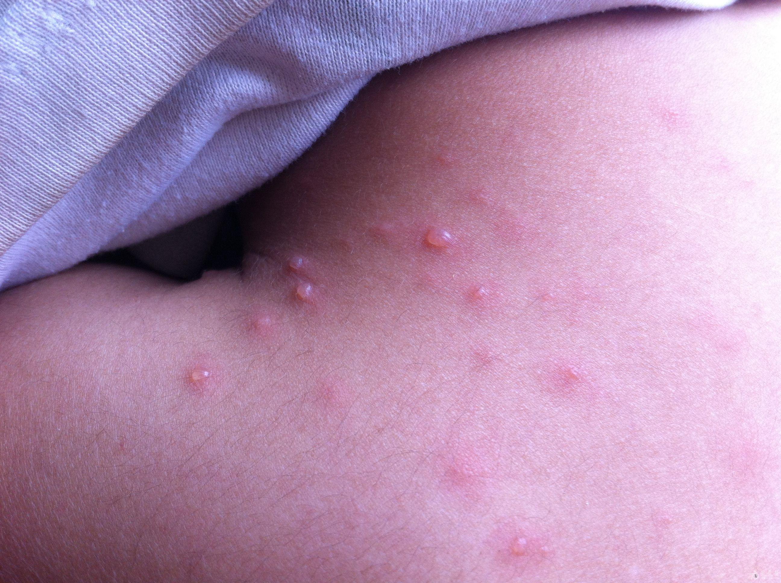 感染发炎的水痘图片图片