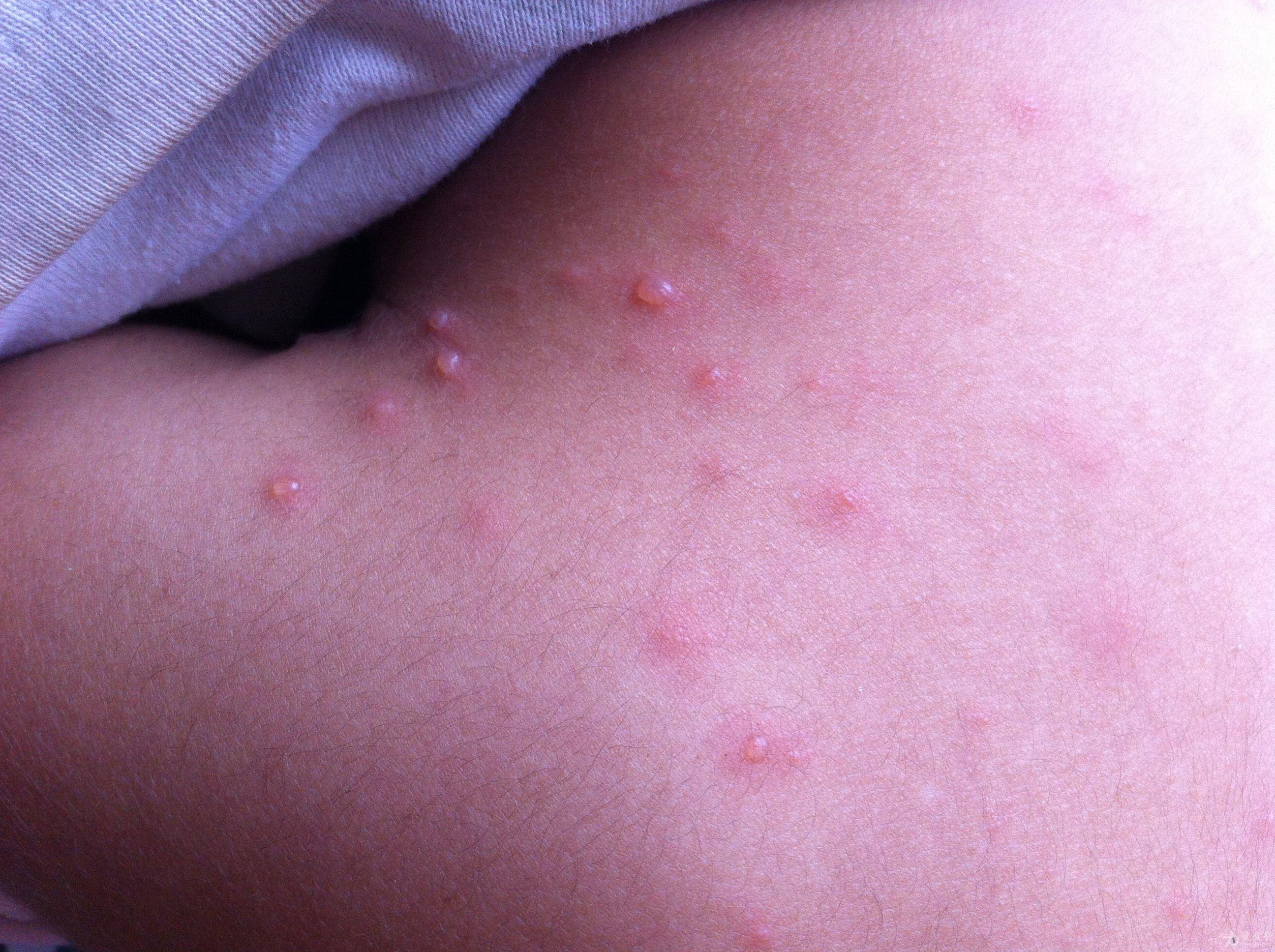 水痘初期症状图片图图片