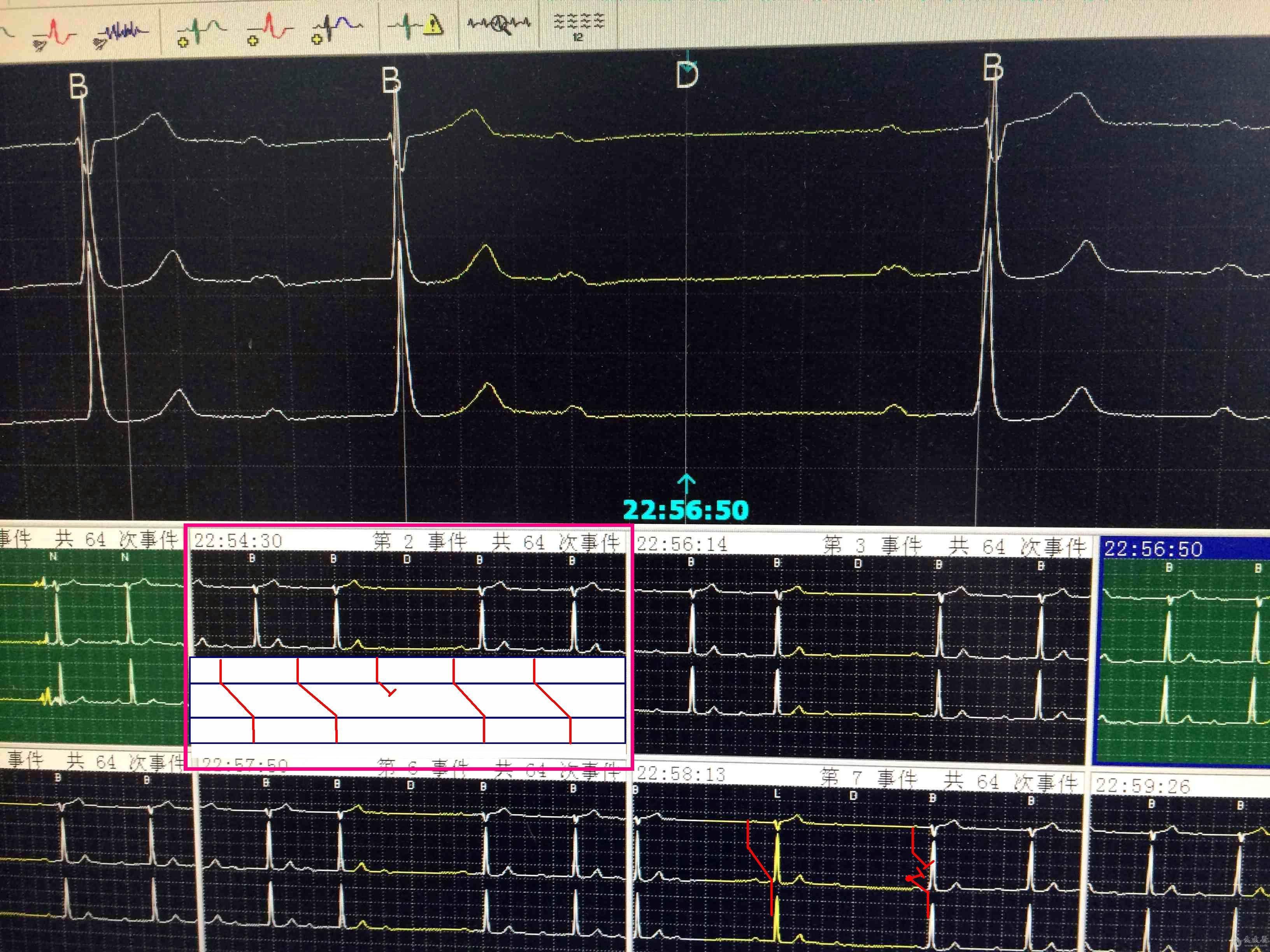 这个是下三度房室传导阻滞吗 - 心电图脑电图专业讨论版 - 爱爱医医学