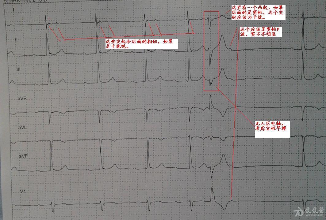 心電圖診斷:竇性心律過緩不齊,i度房室阻滯,室性早搏引起超完全代償