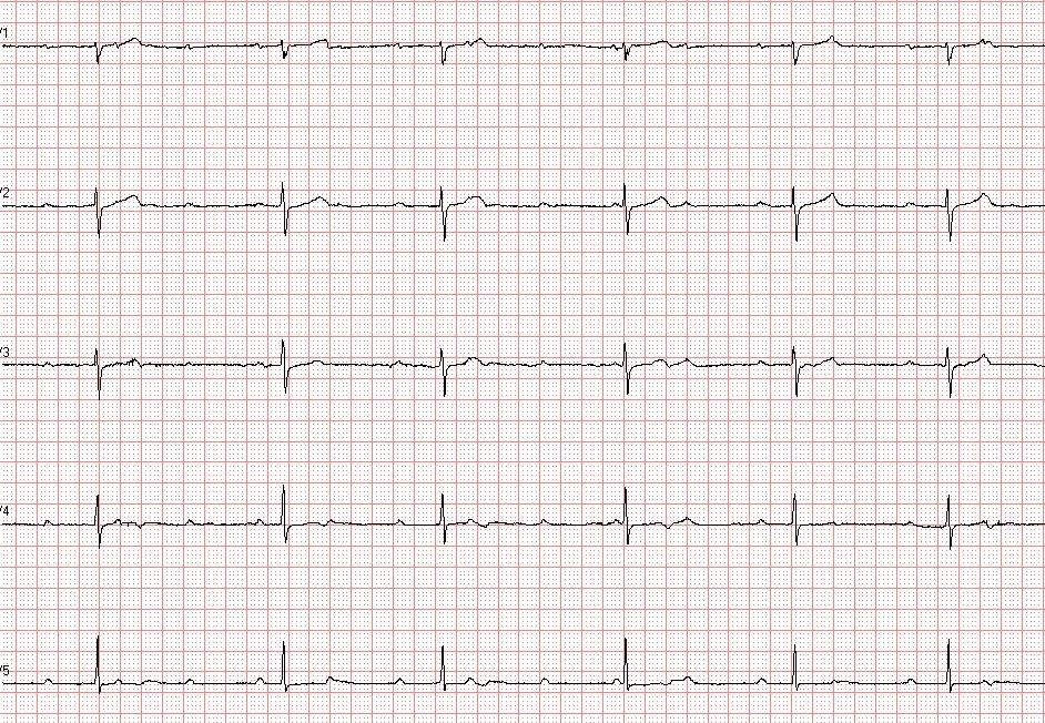 三度房室传导阻滞请老师指导 - 心电图脑电图专业讨论版 - 爱爱医医学
