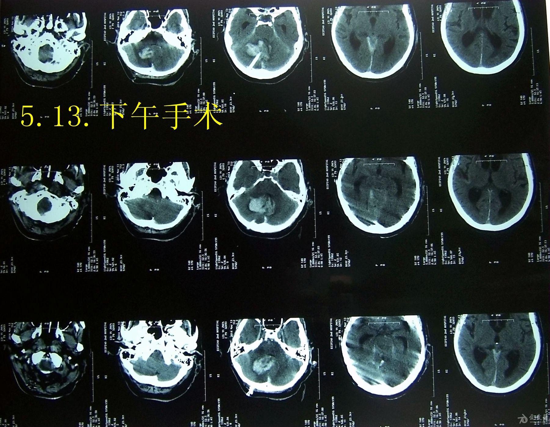 ct下微創穿刺治療小腦出血