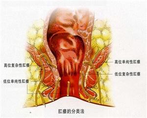 肛瘘治疗经验讨论