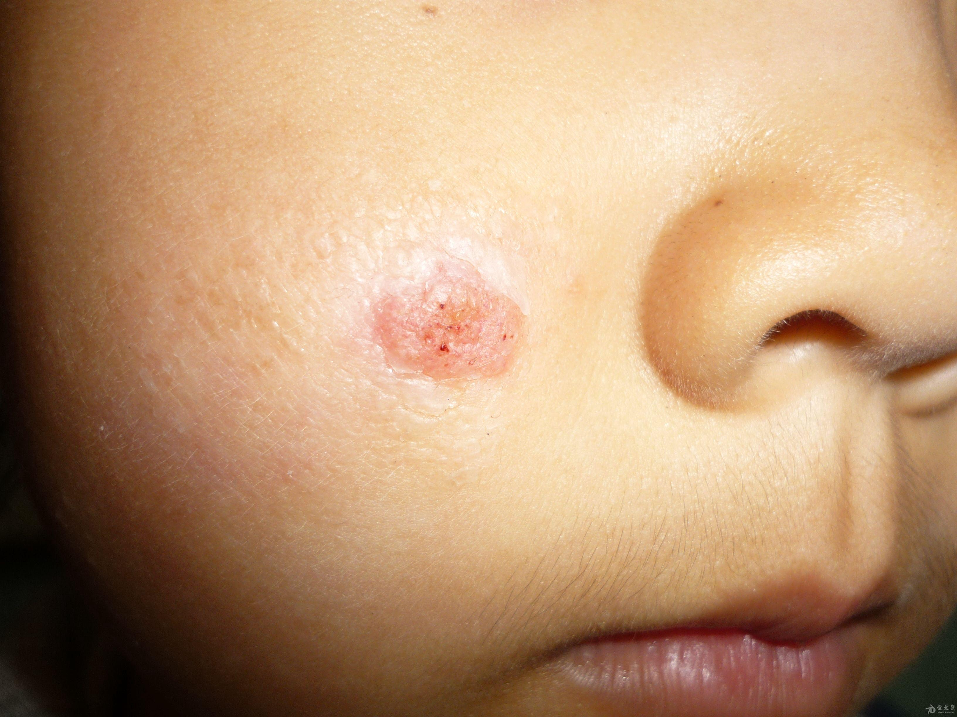 典型病例——儿童孢子丝菌病
