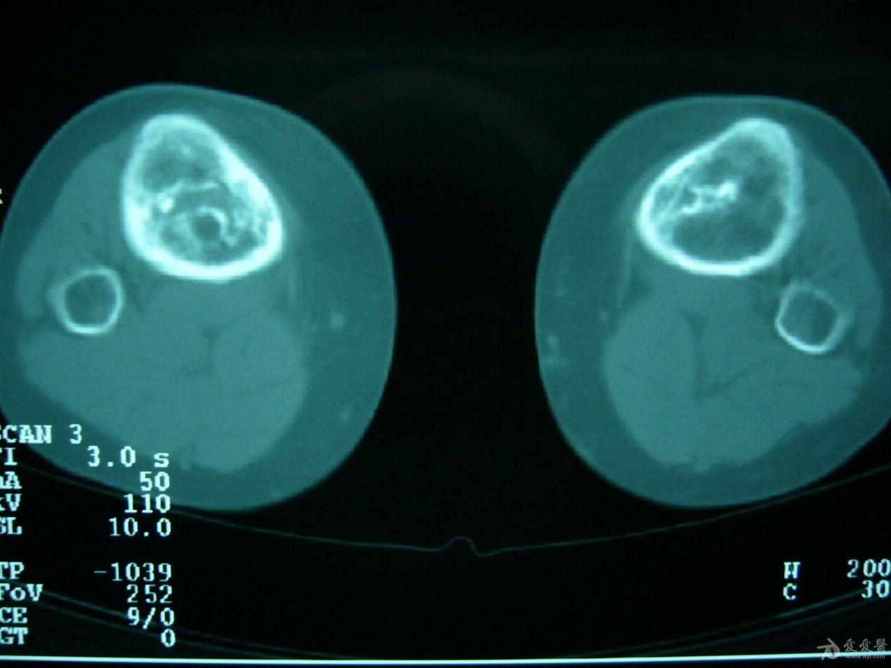 雙側膝關節疼痛ct檢查