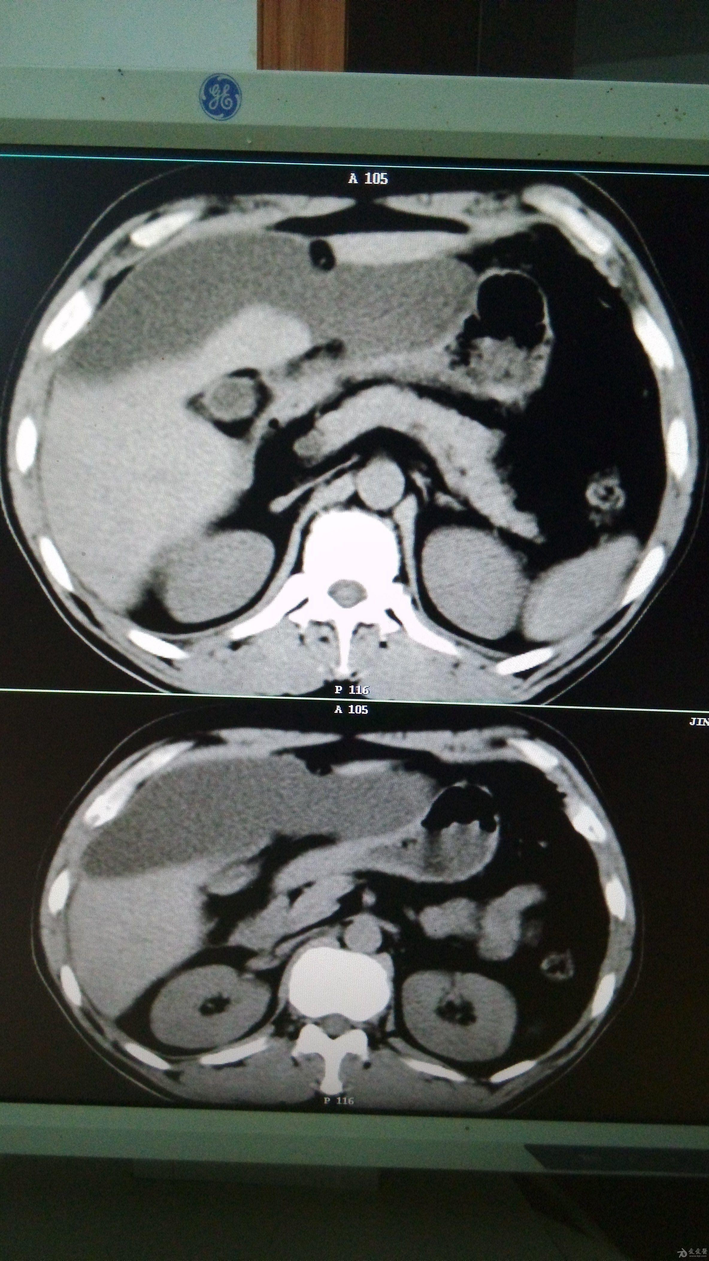 比较有意思的腹部ct