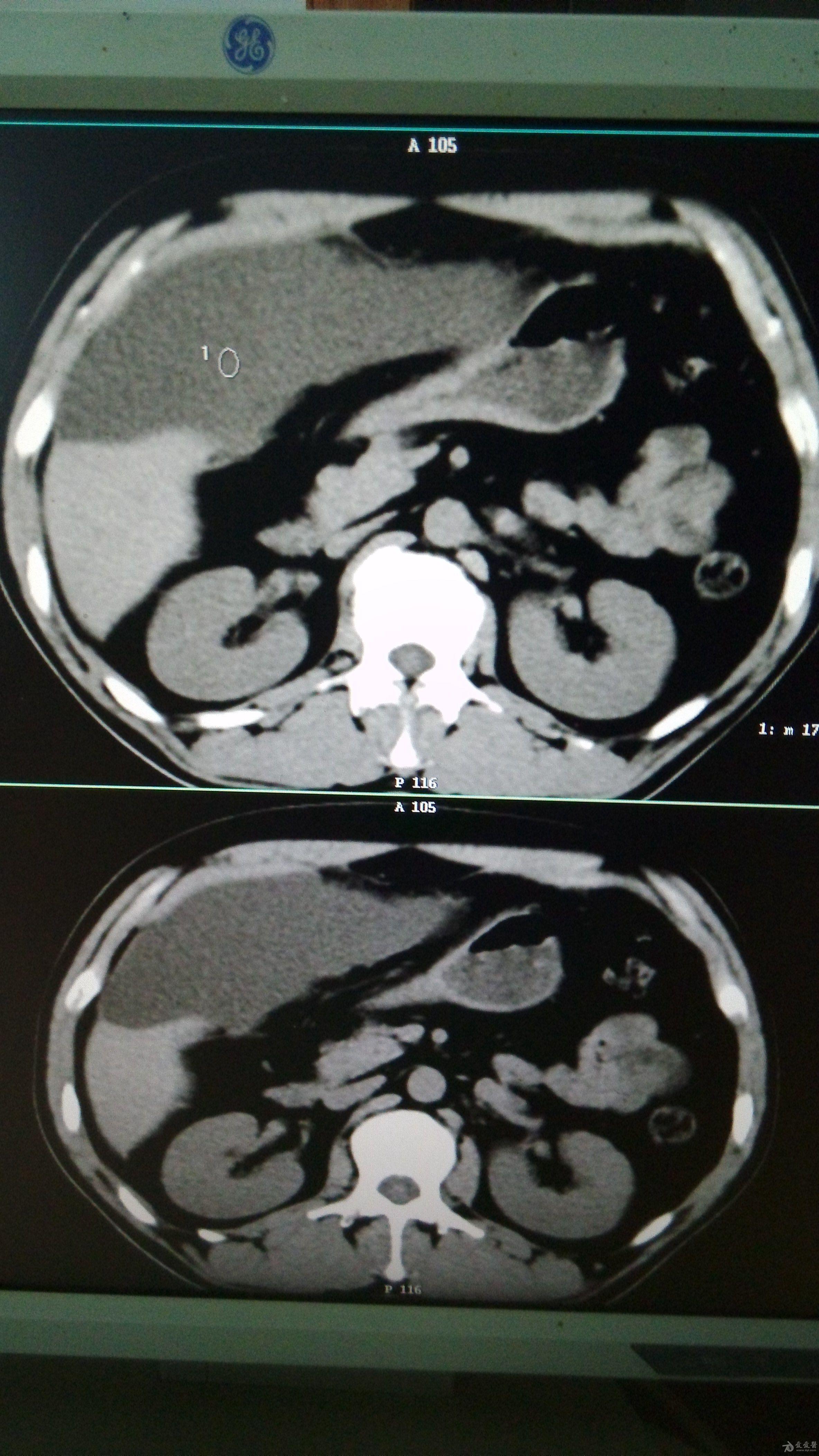 比较有意思的腹部ct