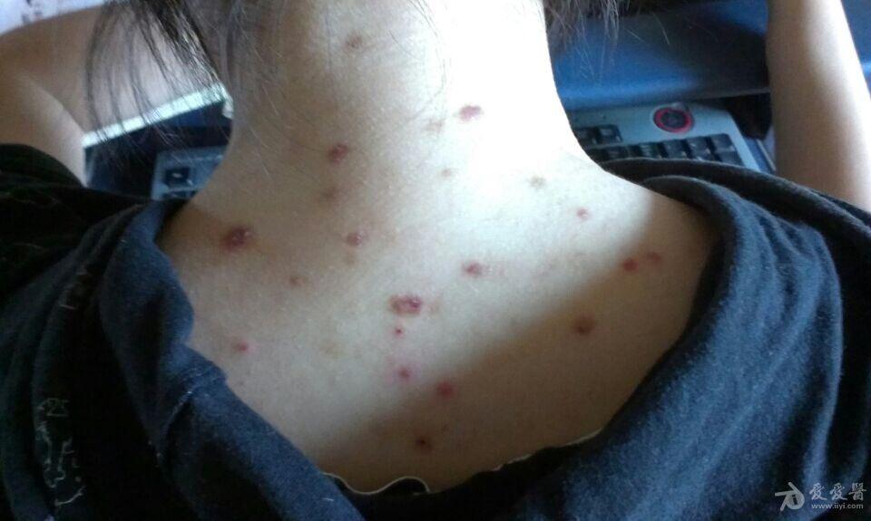 看看女儿后背是啥皮肤病 - 皮肤及性传播疾病讨论版 - 爱爱医医学论坛