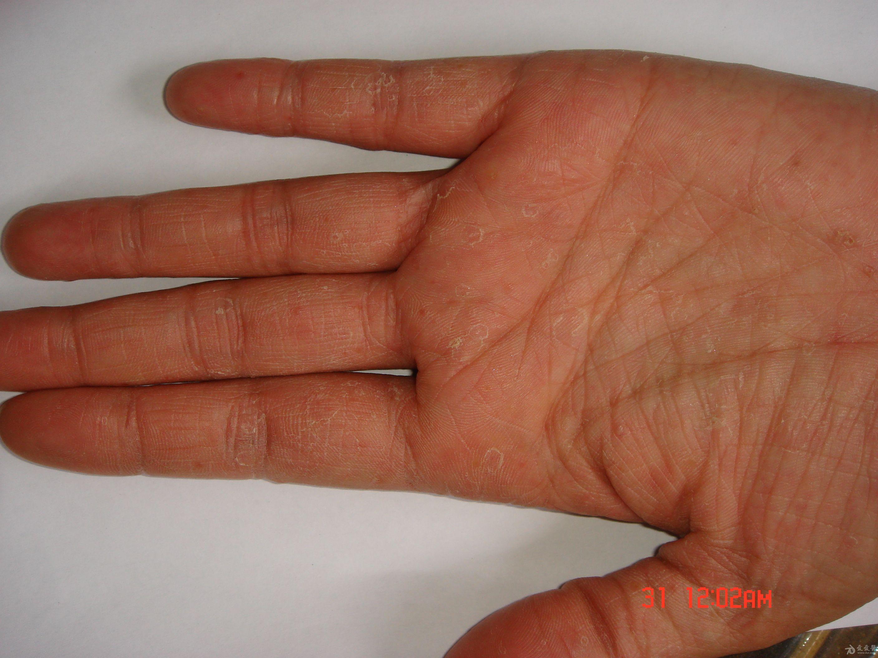 手掌皮肤角化症图片图片