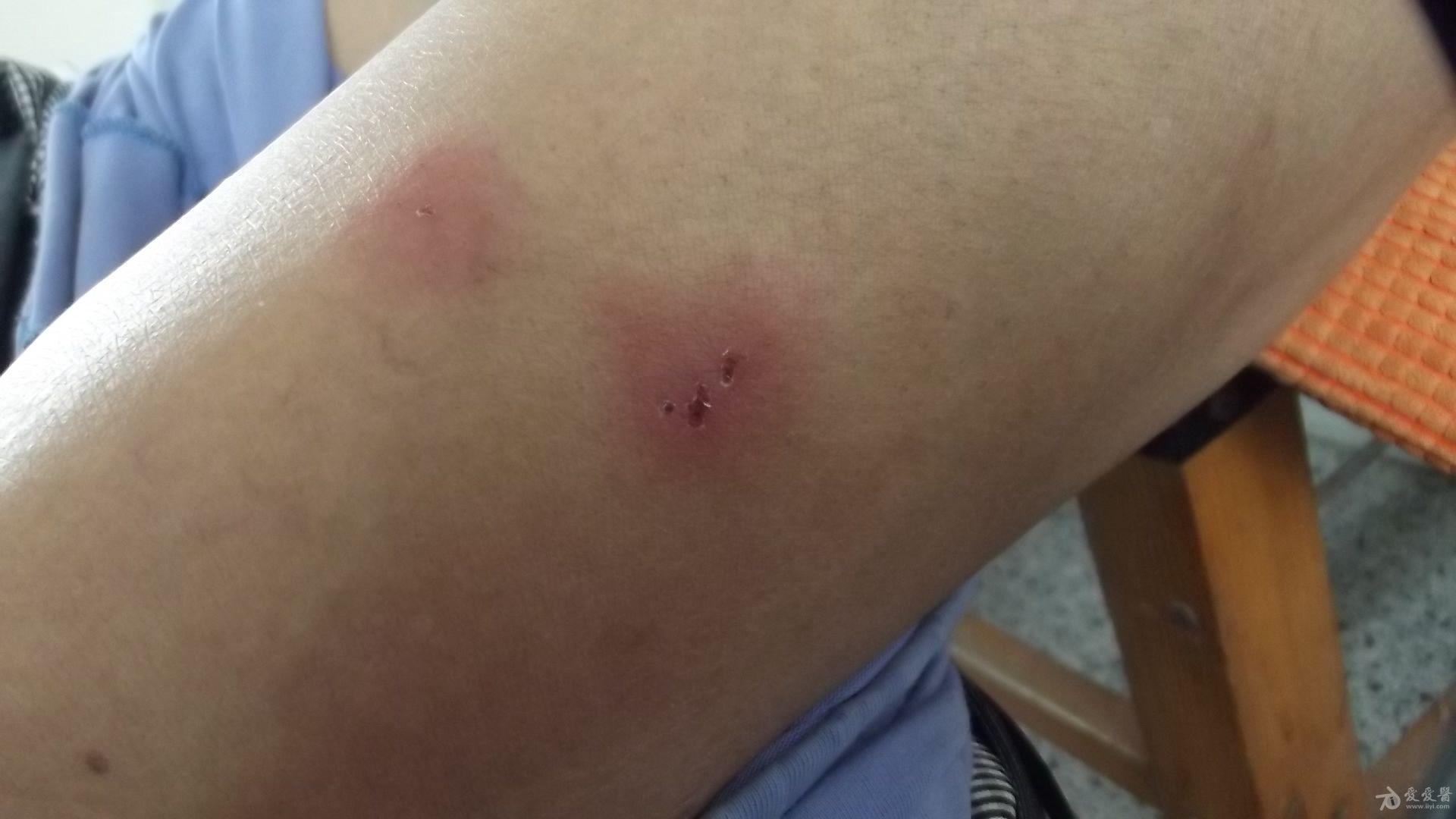 大腿皮损4天老师们看看是带状疱疹吗